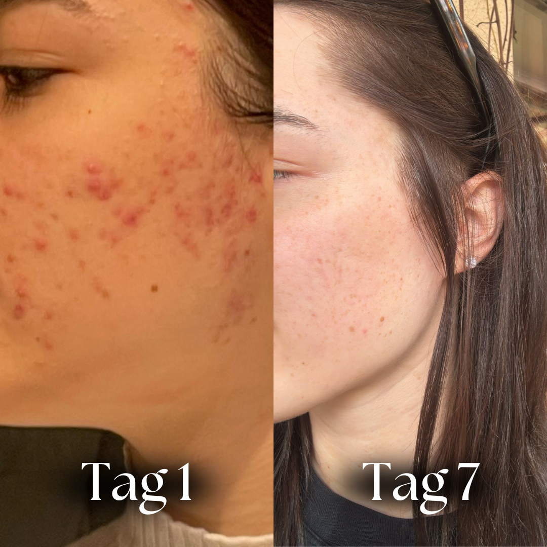 Natürliche Anti-Pickel Seife