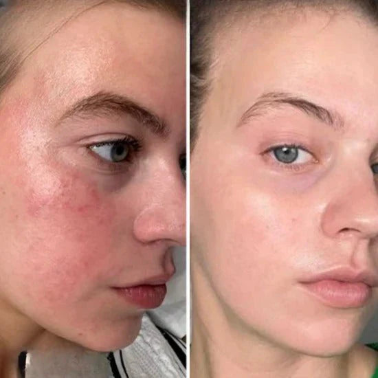 🌹 Lumerasskin Rosenwasser mit Glycerin